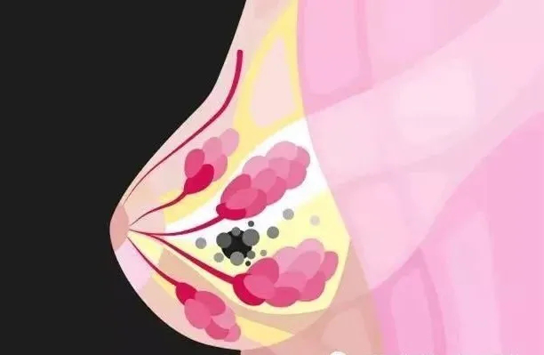 6月14日乳腺增生?乳腺结节?乳腺纤维瘤?到底什么才是乳腺癌诱因?1.png