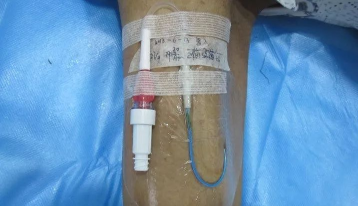 6月24日乳腺癌术后PICC置管患者，血压应该测哪一侧？1.png
