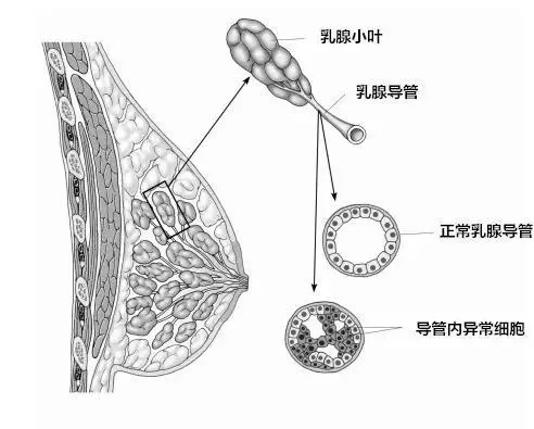 7月9日6 种类型的乳腺癌，你了解多少？1.png