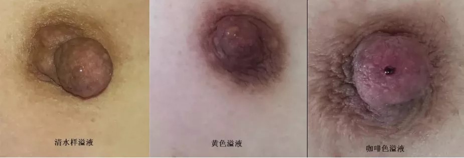 7月22日正确认识乳头溢液1.jpg
