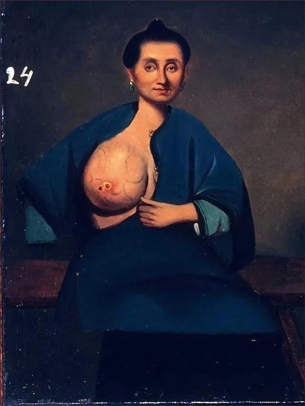 8月8日触目惊心的乳腺癌，原来早藏在了16世纪的名画里4.png