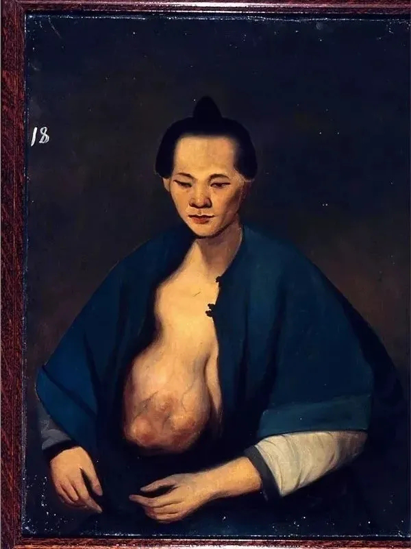 8月8日触目惊心的乳腺癌，原来早藏在了16世纪的名画里6.png