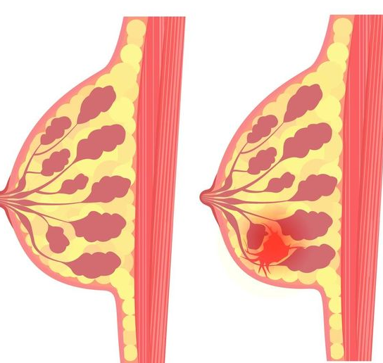 乳腺导管瘤术后照片图片